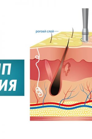 Процедура микродермабразия и микротоки