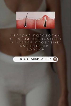 Вросший волос